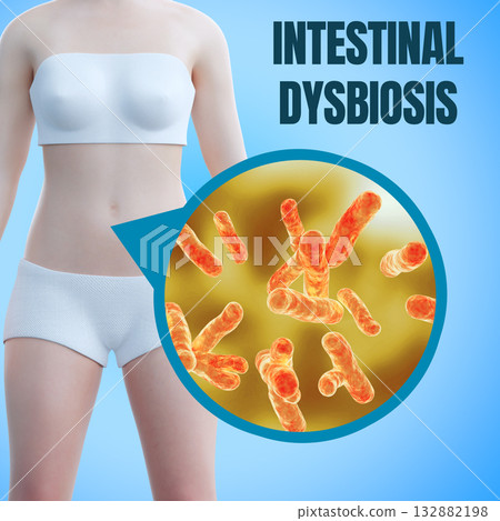 Intestinal dysbiosis is an imbalance of the gut microbiota between harmful and beneficial bacteria Intestinal dysbiosis is an imbalance of the gut microbiota between harmful and beneficial bacteria 132882198