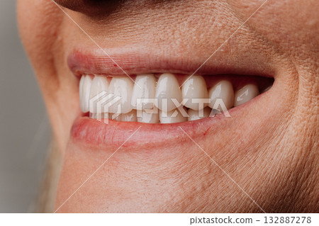 Side view of mature woman smile with white porcelain veneers and natural lips 132887278