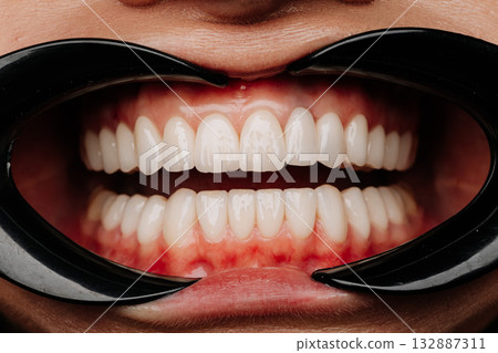 Dental exam with cheek retractors showing white veneers and natural teeth closeup 132887311