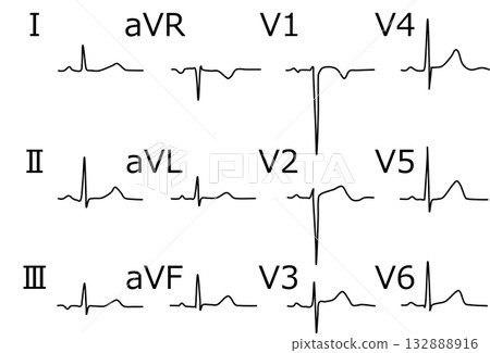 Electrocardiogram graphic material illustration Electrocardiogram graphic material illustration 132888916