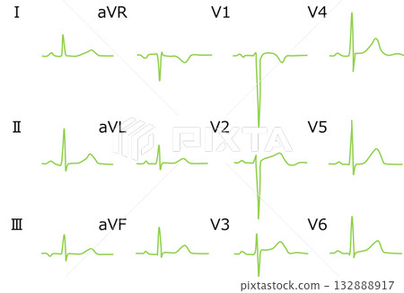 Electrocardiogram graphic material illustration Electrocardiogram graphic material illustration 132888917