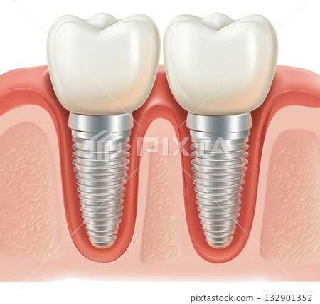 Dental Implants Cross Section Dental Implants Cross Section 132901352