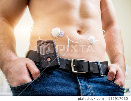 Diabetic man with an insulin pump connected in his abdomen and keeping the insulin pump 132917080