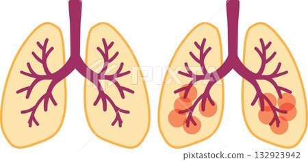 肺 132923942