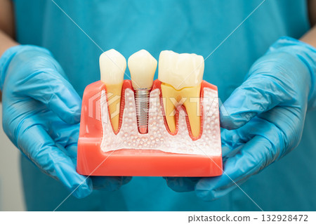 Asian dentist holding dental implant, artificial tooth roots into jaw, root canal of dental treatment, gum disease, teeth model for dentist. 132928472