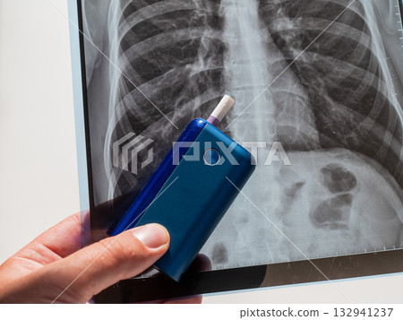 Electronic cigarette and lung x-ray. Tobacco heating system. Electronic cigarette and lung x-ray. Tobacco heating system. 132941237