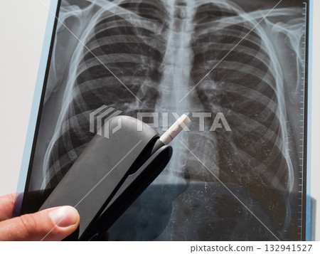 Electronic cigarette and lung x-ray. Tobacco heating system.  132941527