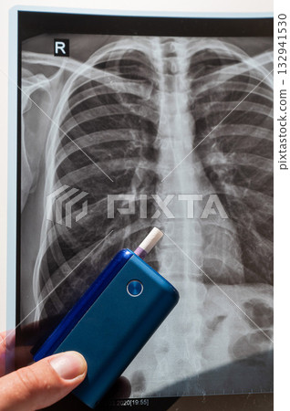 Electronic cigarette and lung x-ray. Tobacco heating system.  132941530