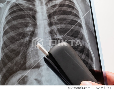Electronic cigarette and lung x-ray. Tobacco heating system.  132941955