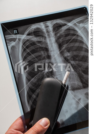 Electronic cigarette and lung x-ray. Tobacco heating system. Electronic cigarette and lung x-ray. Tobacco heating system. 132942029