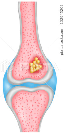Bone Cancer Cross Section illustration 132945202