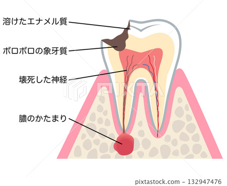 牙齒橫切面顯示嚴重齲壞，牙根神經內積聚膿液－根管治療 132947476