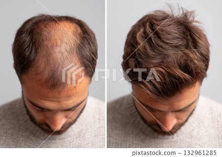 Comparison of Thinning and Thick Hair on Men's Heads 132961285
