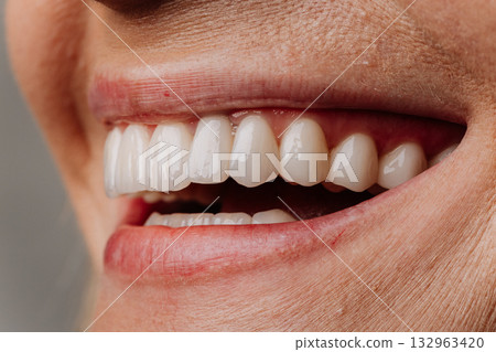 Closeup of bright white veneers on mature woman smile, natural dental result Closeup of bright white veneers on mature woman smile, natural dental result 132963420