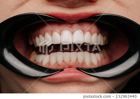 Dental exam with cheek retractors showing white veneers and natural teeth closeup 132963440