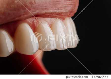 Macro side view of glossy porcelain veneers and natural lips on black background Macro side view of glossy porcelain veneers and natural lips on black background 132963444