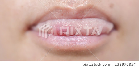 Mouth Ulcer Sore or Aphthous Stomatitis. Oral Health and Medical concepts Mouth Ulcer Sore or Aphthous Stomatitis. Oral Health and Medical concepts 132970834