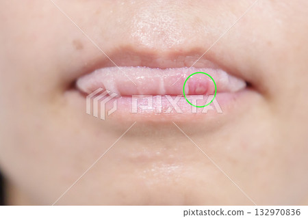 Mouth Ulcer Sore or Aphthous Stomatitis. Oral Health and Medical concepts 132970836