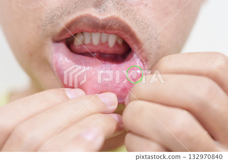 Mouth Ulcer Sore or Aphthous Stomatitis. Oral Health and Medical concepts 132970840