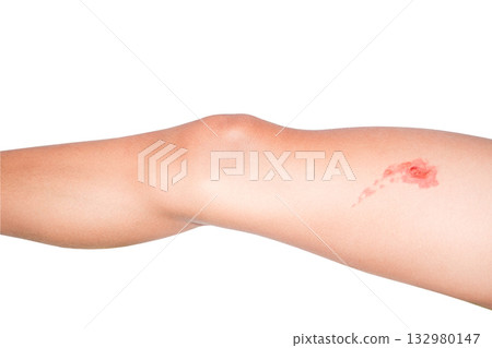 burn with blisters on boy leg, isolated on white with clipping path burn with blisters on boy leg, isolated on white with clipping path 132980147