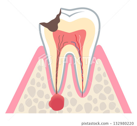 牙齒橫切面顯示嚴重齲壞，牙根神經內積聚膿液－根管治療 132980220