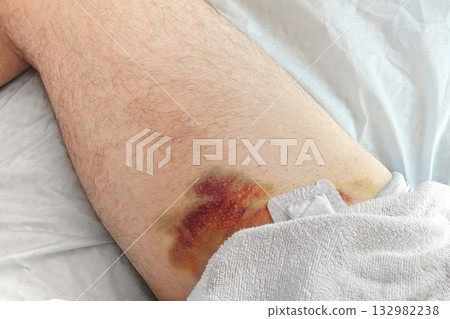 Hematoma on a men's leg close-up. Huge bruise on the leg of a man after endovascular repair due to taking blood thinning medication drugs. Doctor's hand in blue gloves examining patient. Hemorrhage Hematoma on a men's leg close-up. Huge bruise on the leg of a man after endovascular repair due to taking blood thinning medication drugs. Doctor's hand in blue gloves examining patient. Hemorrhage 132982238