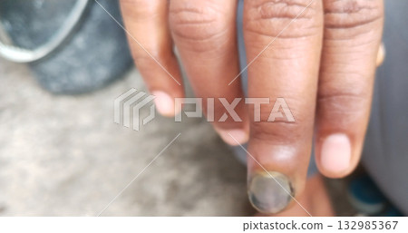 Close-up of four human fingers showing an injured and darkened fingernail on the middle finger due to trauma, representing nail injury, subungual hematoma, and personal health care concept Close-up of four human fingers showing an injured and darkened fingernail on the middle finger due to trauma, representing nail injury, subungual hematoma, and personal health care concept 132985367
