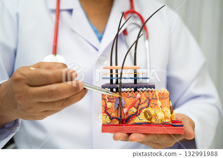 Hair transplant, Asian dermatologist doctor holding skin structure anatomy model for treatment in hospital. 132991988