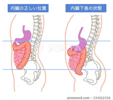 Visceroptosis: A condition in which the internal organs are lowered 133022338