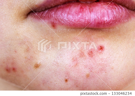 Female face with acne skin problem Female face with acne skin problem 133046234