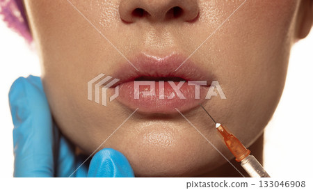 Lip area closeup during filler injection procedure in dermatology clinic Lip area closeup during filler injection procedure in dermatology clinic 133046908