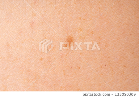 Skin mole spot closeup. Human birthmark, nevus macro texture 133050309