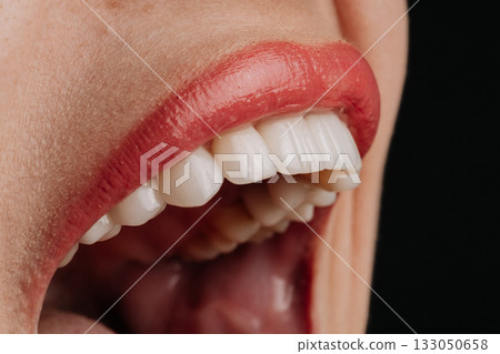 Macro view of open mouth with white porcelain veneers and glossy red lips on black 133050658