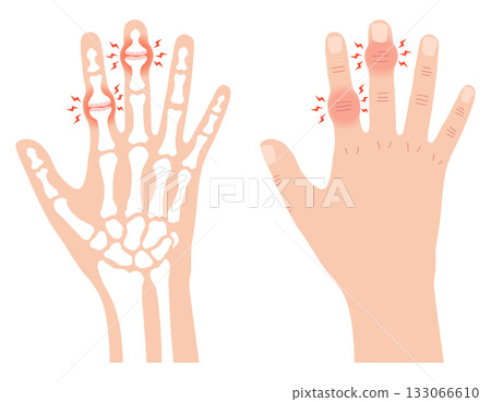 Heberden's node and Bouchard's node 133066610