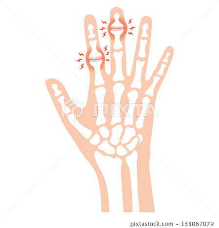 赫伯登節點和布沙爾節點 赫伯登節點和布沙爾節點 133067079