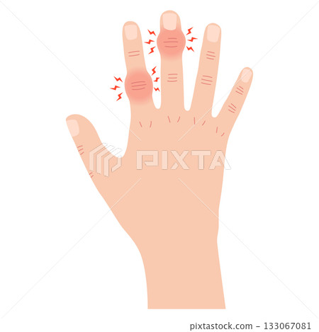 赫伯登節點和布沙爾節點 赫伯登節點和布沙爾節點 133067081