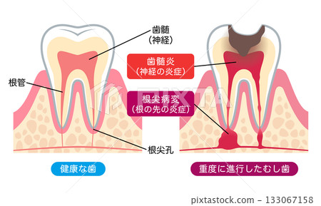 Healthy teeth and advanced cavities: Internal structure of teeth 133067158