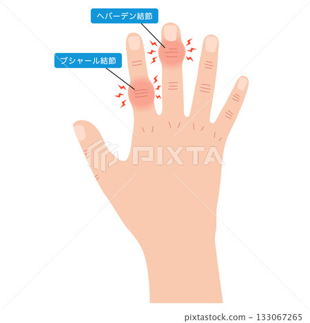 Heberden's node and Bouchard's node 133067265