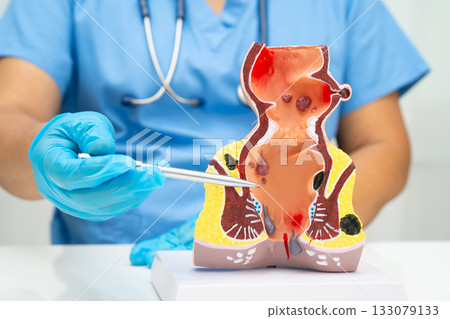 Asian doctor with rectum and hemorrhoid human anatomy model at hospital, inflamed vascular structure. 133079133