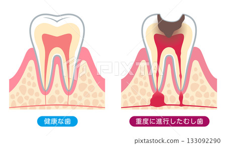 健康的牙齒和嚴重的齲齒:牙齒的內部結構 健康的牙齒和嚴重的齲齒:牙齒的內部結構 133092290