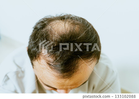 Early baldness, thinning hair, weak and fine hair, beauty concept, A closeup of a half-bald male head, hair transplant concept for hair loss 133102088