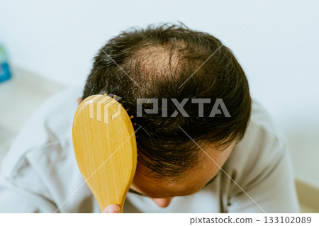 Early baldness, thinning hair, weak and fine hair, beauty concept, A closeup of a half-bald male head, hair transplant concept for hair loss 133102089