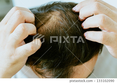 Early baldness, thinning hair, weak and fine hair, beauty concept, A closeup of a half-bald male head, hair transplant concept for hair loss 133102090