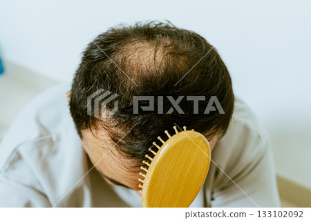 Early baldness, thinning hair, weak and fine hair, beauty concept, A closeup of a half-bald male head, hair transplant concept for hair loss 133102092