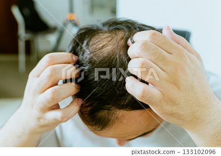 Early baldness, thinning hair, weak and fine hair, beauty concept, A closeup of a half-bald male head, hair transplant concept for hair loss Early baldness, thinning hair, weak and fine hair, beauty concept, A closeup of a half-bald male head, hair transplant concept for hair loss 133102096
