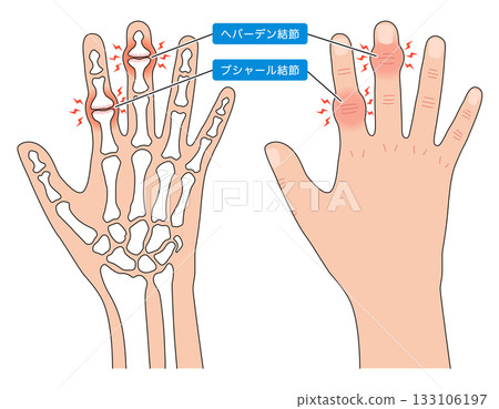 赫伯登節點和布沙爾節點 赫伯登節點和布沙爾節點 133106197