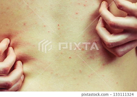 Woman scratching her itchy back with allergy rash 133111324