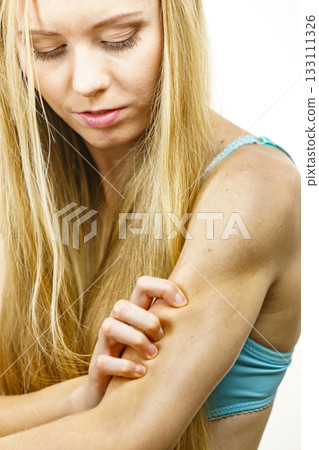 Woman scratching her itchy arm. Skin allergy. 133111326