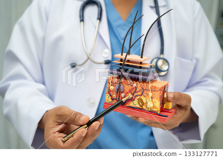 Hair transplant, Asian dermatologist doctor holding skin structure anatomy model for treatment in hospital. Hair transplant, Asian dermatologist doctor holding skin structure anatomy model for treatment in hospital. 133127771