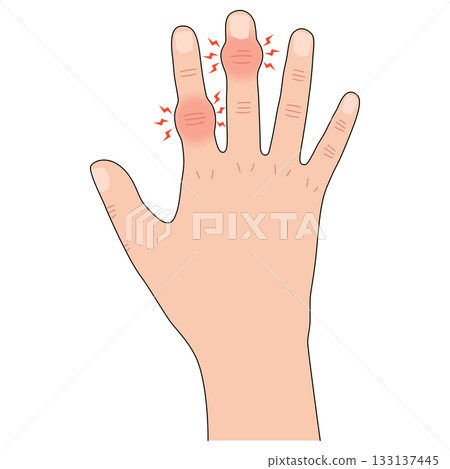 赫伯登節點和布沙爾節點 赫伯登節點和布沙爾節點 133137445